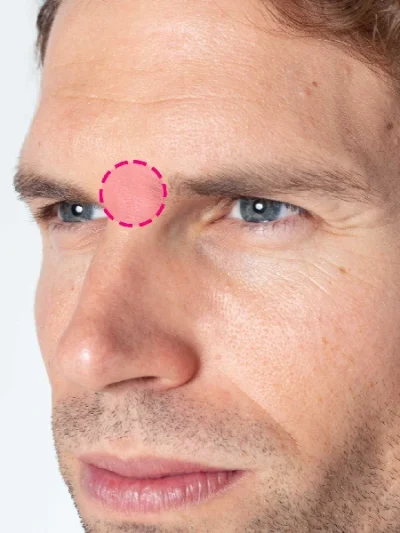 Depilação a laser de díodo na zona do entre sobrancelhas masculino antes e depois do tratamento