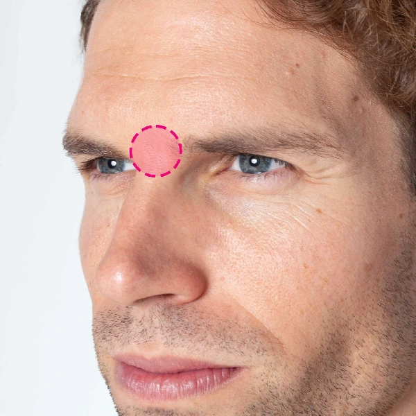 Depilação a laser de díodo na zona do entre sobrancelhas masculino antes e depois do tratamento