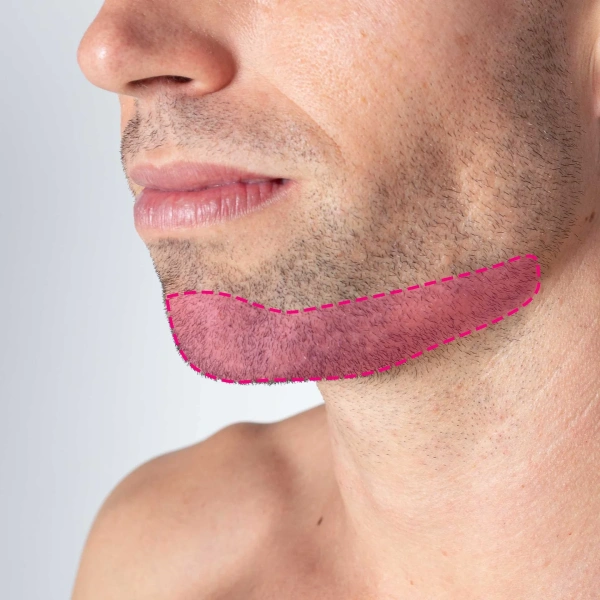 Depilação a laser no queixo homem
