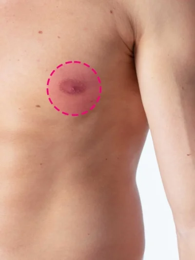 Depilação a laser da aréola masculina com tecnologia de díodo de última geração