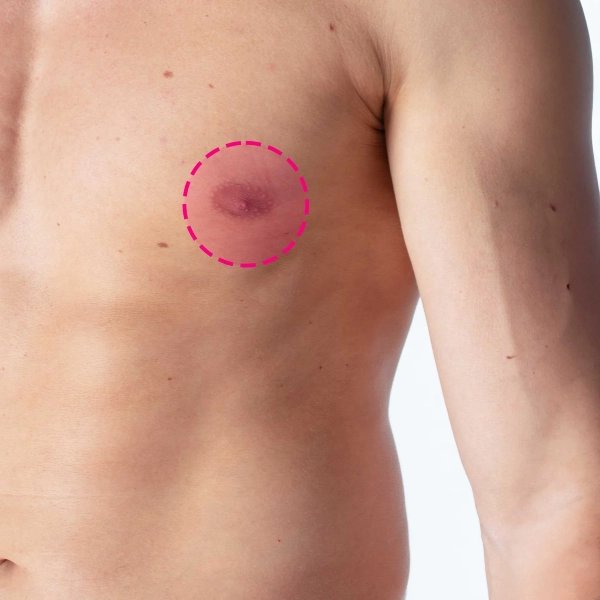 Depilação a laser da aréola masculina com tecnologia de díodo de última geração