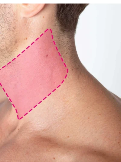 Depilação a laser de díodo em pescoço masculino com remoção progressiva e duradoura do pelo