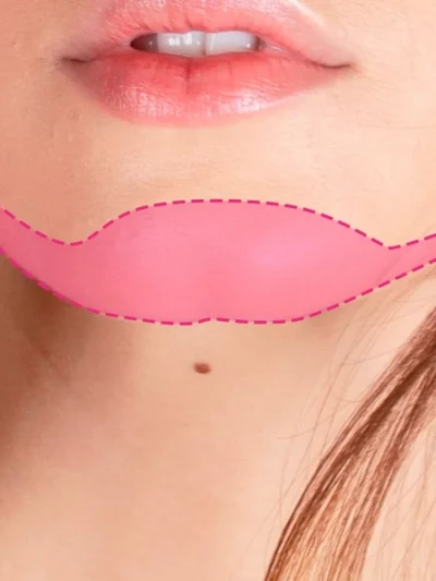 Depilação a laser no queixo feminino para eliminação do vello facial