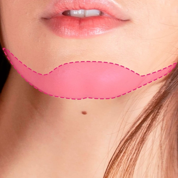 Depilação a laser no queixo feminino para eliminação do vello facial