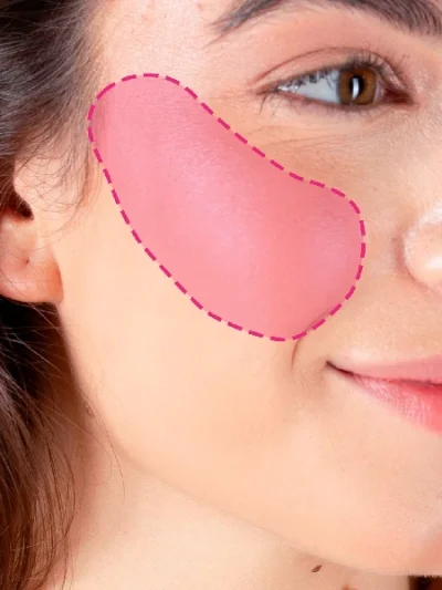 Depilação a laser nos pómulos femininos para remoção de vello facial nas bochechas