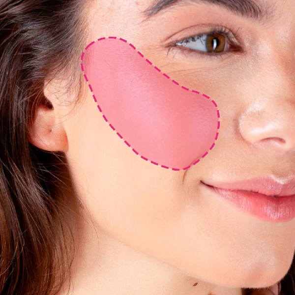 Depilação a laser nos pómulos femininos para remoção de vello facial nas bochechas