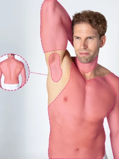 Depilação a laser para a parte superior do corpo com tecnologia de díodo