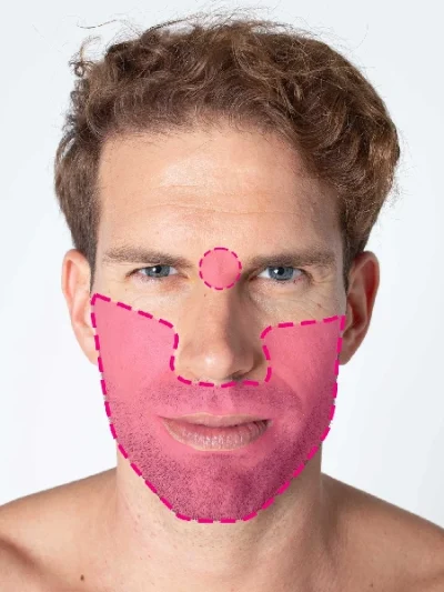 Depilação laser de díodo para facial completo masculino com tecnologia de última geração.