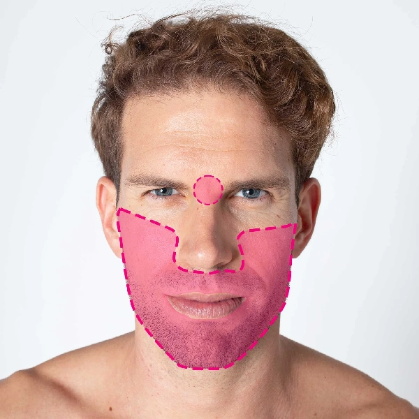 Depilação laser de díodo para facial completo masculino com tecnologia de última geração.