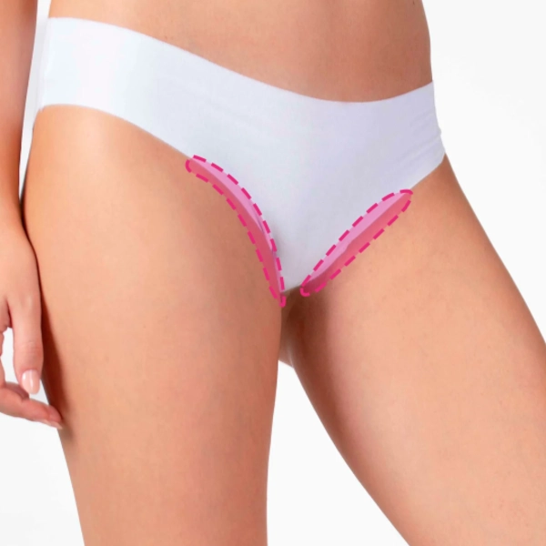 Depilação a laser nas virilha femininas com tecnologia de diodo