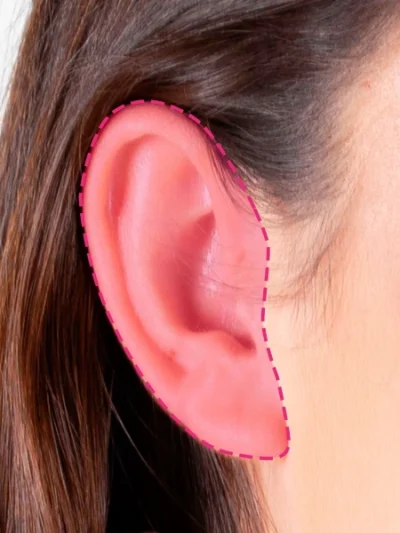 Depilação a laser nas orelhas femininas para remoção de vello na zona auricular