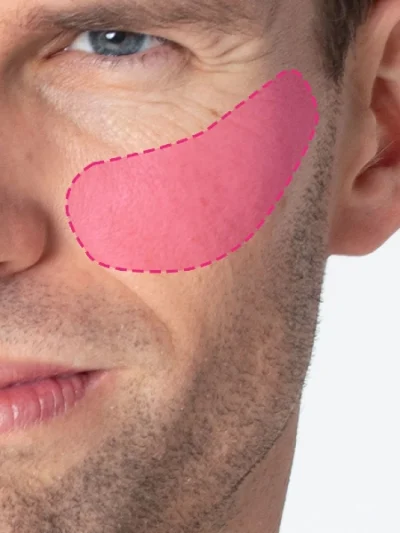 Depilação a laser nos pómulos homem