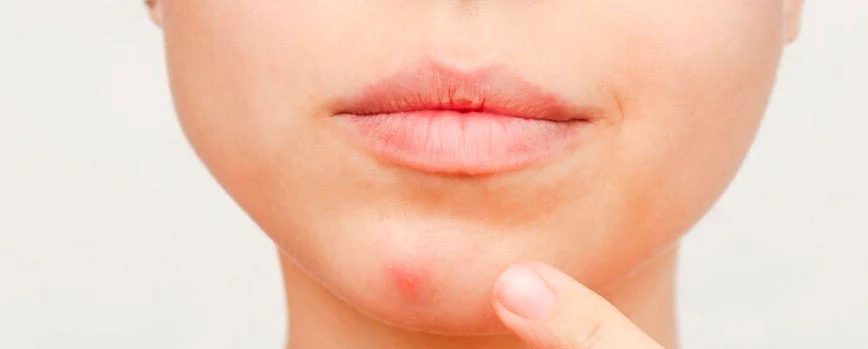 pelos enquistados causas tratamento como eliminá