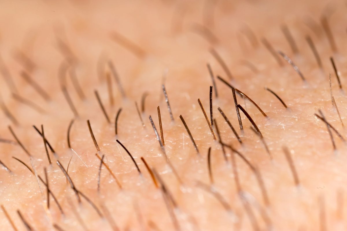 hipertricose depilação laser solução definitiva excesso